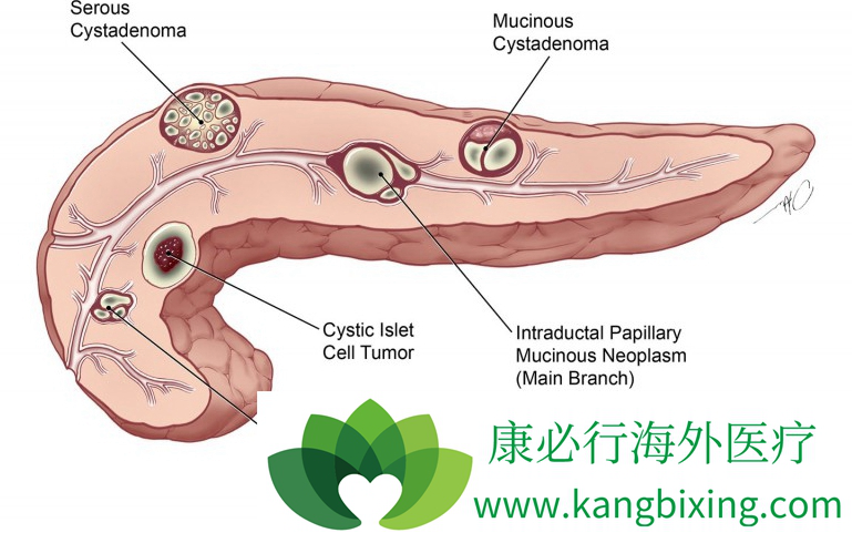 黄疸是一种常见的得了胰腺癌症状