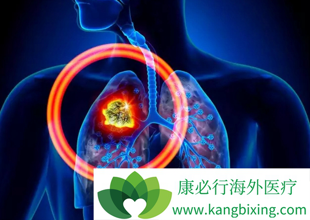 照顾肺癌患者也得癌是因为晚期肺癌会传染吗