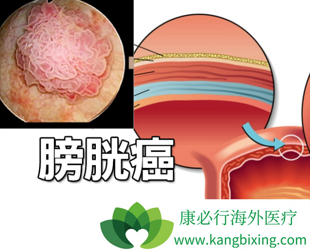 血尿的出现是膀胱癌症状之一