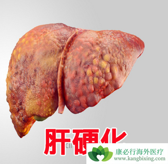 肝硬化治疗该如何做?