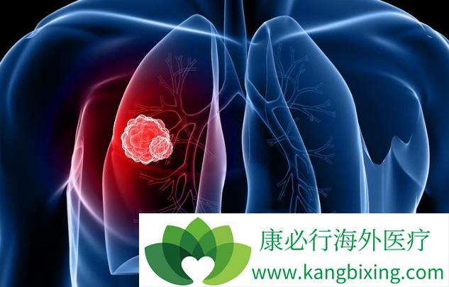 到了肺癌晚期会有哪些肺癌的症状?