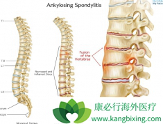 �����İ�֢ǿֱ��Ҫ����֢�ַ�����Ϊ��Ҫ����