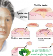 �˽�Ƥ����֢״��������ǰԤ��Ƥ����