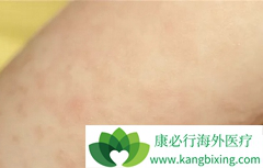 ����ҩ��Ϊ��ҽ�������Ҫ������Ƥ����֢״