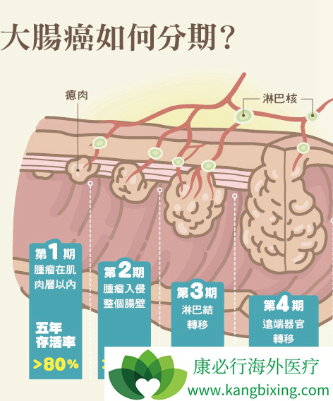 结肠癌早期的5大症状图片