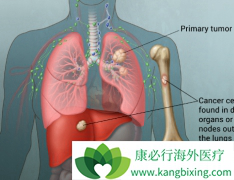 PD-1���Ƽ�Keytruda������Ϊ���ڷΰ�������ѡ