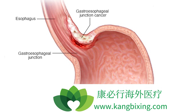 贲门癌的中期症状图片图片