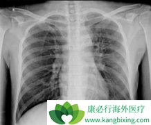 PD-1������Ϊ���ڷΰ�������ѡ����