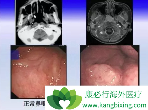 鼻咽癌症状 鼻咽癌症状