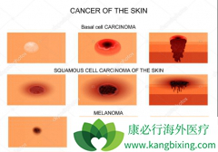 �˽�����Ƥ����֢״�����ھ��緢�ְ�֢��������