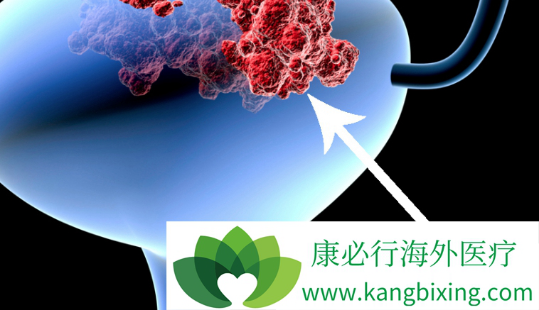 膀胱癌症状 膀胱癌症状