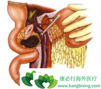 ���߳����ǲ�˹��֢���ٰ�֢״���ܻ���