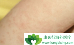 ����Ƥ����֢״��Ϊ���׽�Ӳ�߿�״����