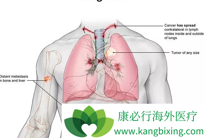肺癌晚期化疗 肺癌晚期化疗