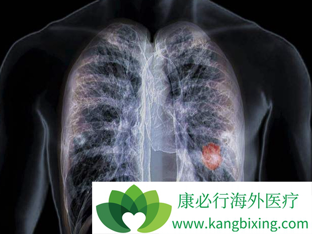 肺癌晚期化疗 肺癌晚期化疗