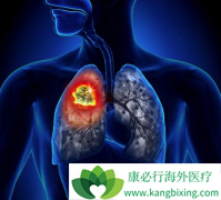 ��ϸ��ת�Ƶ�ȫ���ΰ�������ʲô֢״