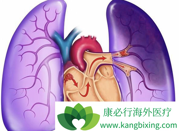 什么是非小细胞肺癌 什么是非小细胞肺癌