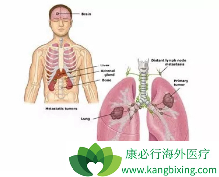 肺癌晚期能活多久 肺癌晚期能活多久