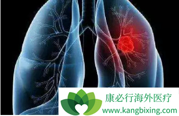 肺癌晚期症状 肺癌晚期症状