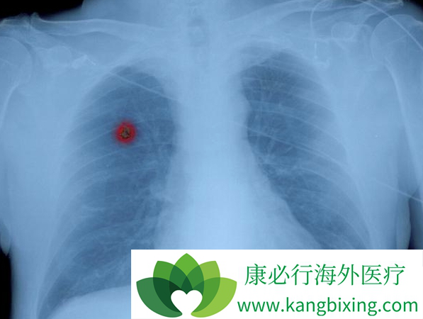 晚期肺癌治疗 晚期肺癌治疗