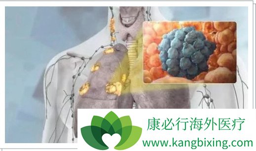 晚期肺癌治疗 晚期肺癌治疗