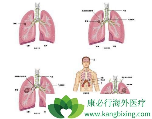 肺癌症状 肺癌症状