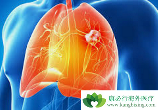 肺癌晚期能活多久 肺癌晚期能活多久