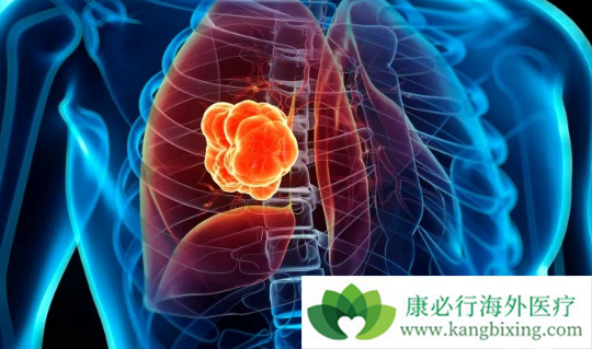 肺癌会传染吗 肺癌会传染吗