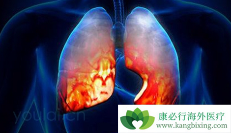 小细胞肺癌 小细胞肺癌