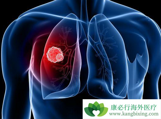 非小细胞肺癌 非小细胞肺癌