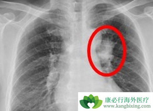 肺癌化疗 肺癌化疗