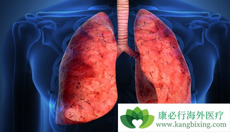 肺癌晚期 肺癌晚期
