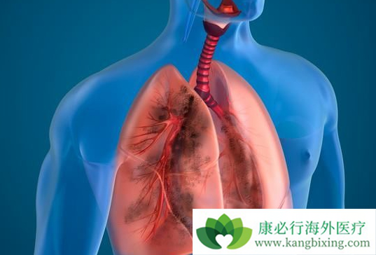 肺癌晚期怎么治疗 肺癌晚期怎么治疗