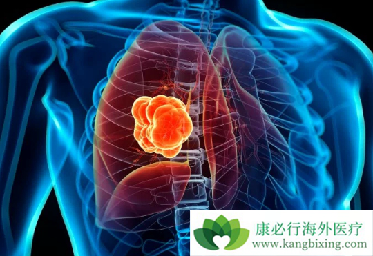 肺癌脑转移 肺癌脑转移