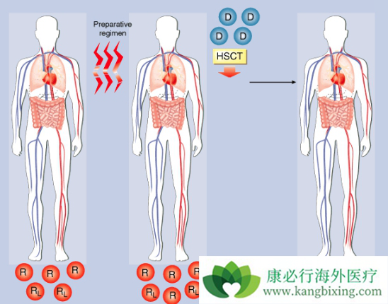 什么是多发性骨髓瘤 什么是多发性骨髓瘤