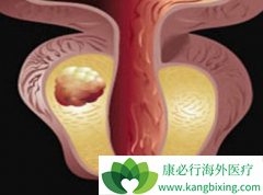 ����ǰ���ٰ�����ʹ�ð�������(Abiraterone)Ԥ�����