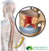 ���˶෢�Թ�������ô�Σ��ڼ�෢�Թ�������ʳ��ע��ʲô��