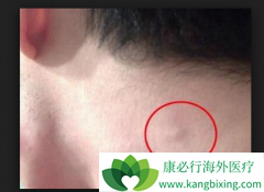 �����ܰͰ�ԭ������Щ���ܰͰ�֢״����Щ