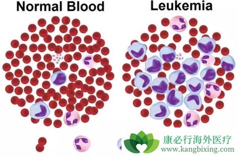 白血病遗传吗 白血病遗传吗