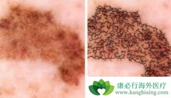 ��ɫ�����������������Щ��PD-1���������ƺ�ɫ������