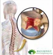 ���ڶ෢�Թ�����֢״��������Щ����