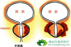 ����ǰ���ٰ�֢״��Ԥ��ǰ���ٰ��ķ���