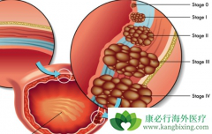 ���д�Ѫ�����ǰ��װ�֢״�ı���