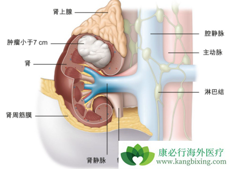 肾癌症状 肾癌症状