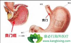 ��ʱ֪���������Ű�֢״����������Ч��