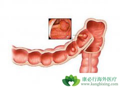 ֱ������ʲô��ֱ����֢״����Щ��