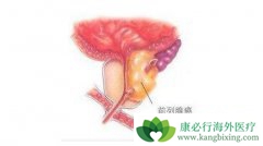 ǰ���ٰ�֢״����Щ��������ʳ����Ԥ��ǰ���ٰ��ķ�����