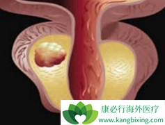 ��������(Abiraterone)�ǽ���ǰ���ٰ������������յ���Чҩ��