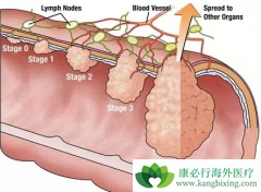 �����ʺ��о��쳣�ۺ����ǰ�ɳ����(Oxaliplatin)�ĺ���������
