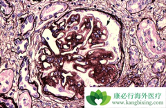 ����������/���޻�����Ĥ�������Ŀ�ͨ��Tregsϸ��Ԥ��